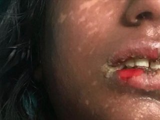 Deri hastalığına yakalanan öğrenci yoğun bakımda