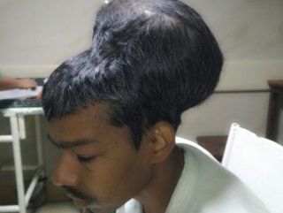 Hindistan’da doktorlar en büyük beyin tümörünü çıkardı