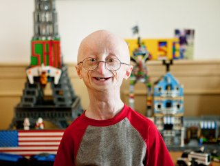 Progeria nedir