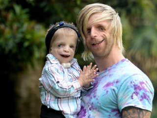 Treacher Collins nedir