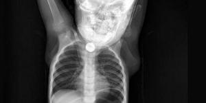 Batman&rsquo;da Berfin Ramazanoğlu&rsquo;nun yuttuğu pil operasyonla alındı!