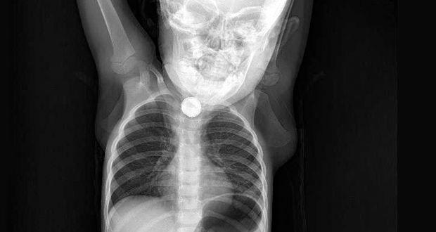 Batman&rsquo;da Berfin Ramazanoğlu&rsquo;nun yuttuğu pil operasyonla alındı!